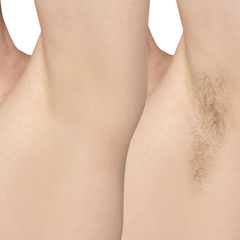 Epilation Lumière Pulsée Avant et Après