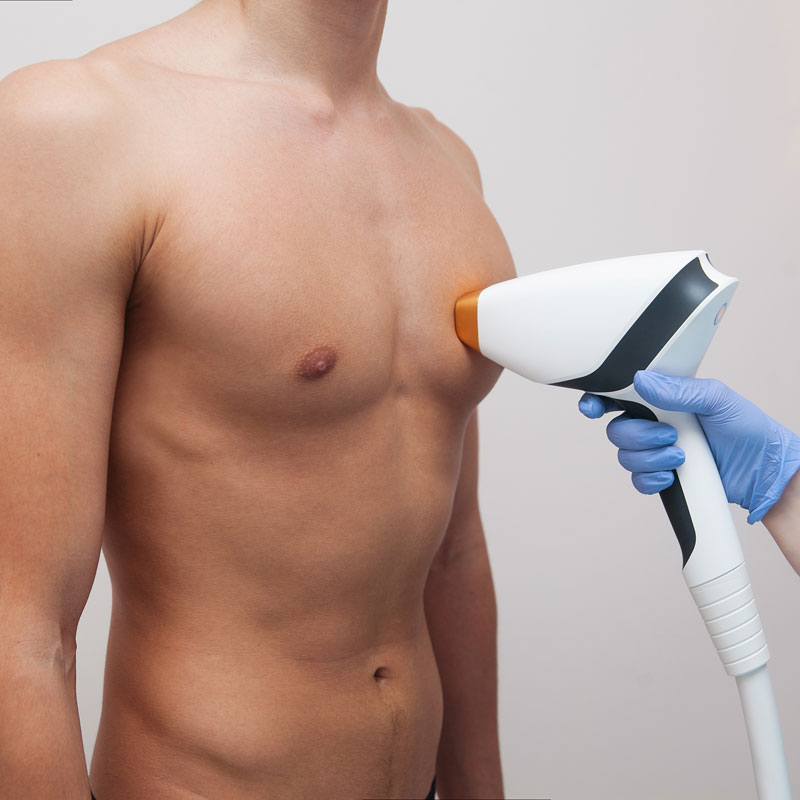 Epilation solution radicale lumière pulsée pour homme